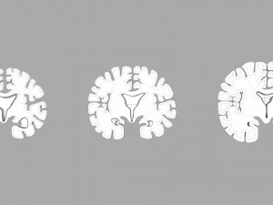 Alzheimer Disease Brain coronal slice 3D Model