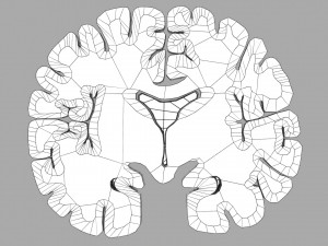 Alzheimer Disease Brain coronal slice 3D Model