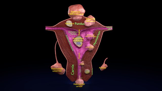 Fibroid Uterus Human female 3D 3D मॉडल .c4d .max .obj .3ds .fbx .stl .blend 