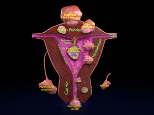 Fibroid Uterus Human female 3D 3D Model