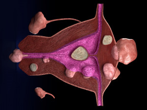 Fibroid Uterus Human female 3D 3D मॉडल