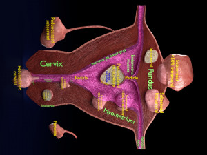 Fibroid Uterus Human female 3D 3D मॉडल