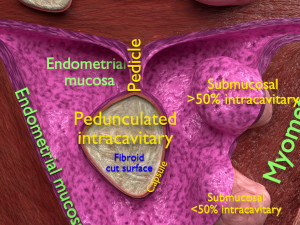 Fibroid Uterus Human female 3D 3D मॉडल