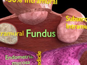 Fibroid Uterus Human female 3D 3D मॉडल