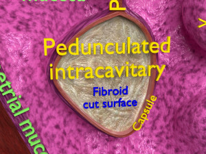 Fibroid Uterus Human female 3D 3D मॉडल