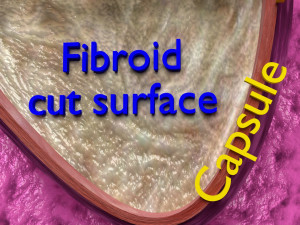 Fibroid Uterus Human female 3D 3D मॉडल
