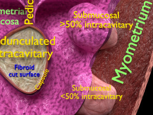 Fibroid Uterus Human female 3D 3D मॉडल