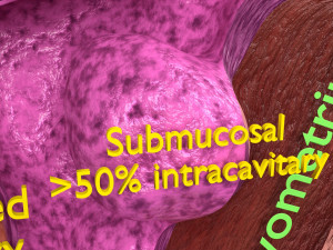 Fibroid Uterus Human female 3D 3D मॉडल