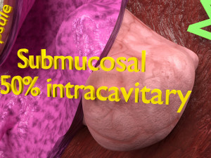 Fibroid Uterus Human female 3D 3D मॉडल