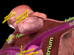 Fibroid Uterus Human female 3D 3D मॉडल