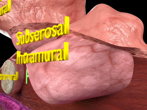 Fibroid Uterus Human female 3D 3D मॉडल