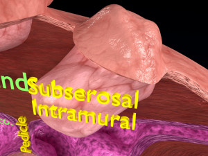 Fibroid Uterus Human female 3D 3D मॉडल