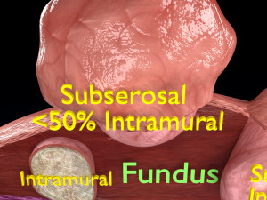 Fibroid Uterus Human female 3D 3D मॉडल