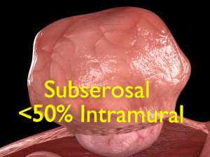 Fibroid Uterus Human female 3D 3D मॉडल