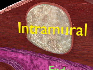 Fibroid Uterus Human female 3D 3D मॉडल