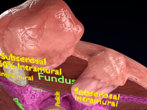 Fibroid Uterus Human female 3D 3D मॉडल