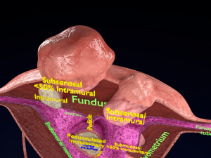 Fibroid Uterus Human female 3D 3D मॉडल