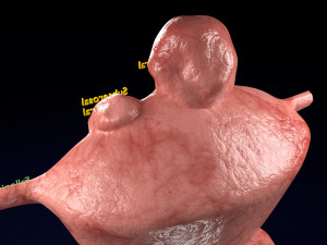 Fibroid Uterus Human female 3D 3D मॉडल