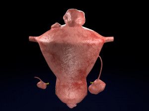 Fibroid Uterus Human female 3D 3D मॉडल