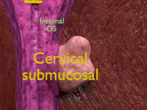 Fibroid Uterus Human female 3D 3D मॉडल