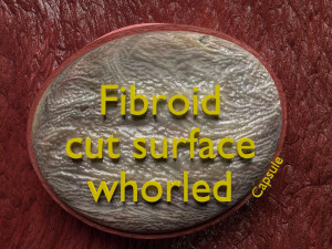 Fibroid Uterus Human female 3D 3D मॉडल