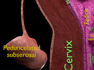 Fibroid Uterus Human female 3D 3D मॉडल