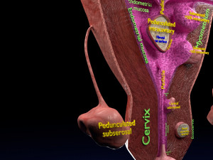 Fibroid Uterus Human female 3D 3D मॉडल