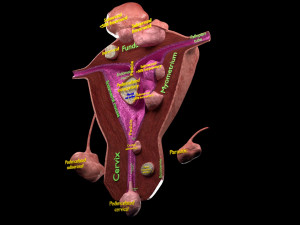 Fibroid Uterus Human female 3D 3D मॉडल
