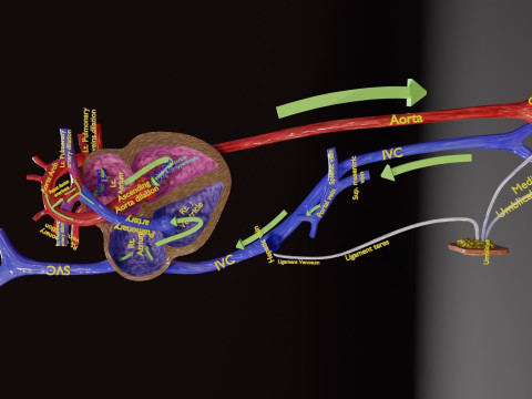 PDA Patent Ductus Arteriosus vs Normal blood circulation 3D Model