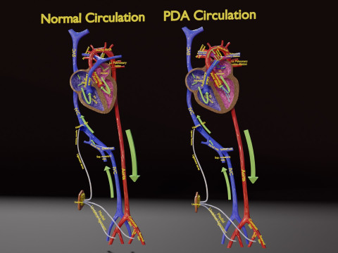 PDA Patent Ductus Arteriosus vs Normal blood circulation 3D Model