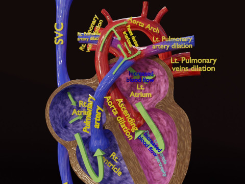 PDA Patent Ductus Arteriosus vs Normal blood circulation 3D Model