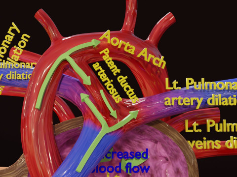 PDA Patent Ductus Arteriosus vs Normal blood circulation 3D Model