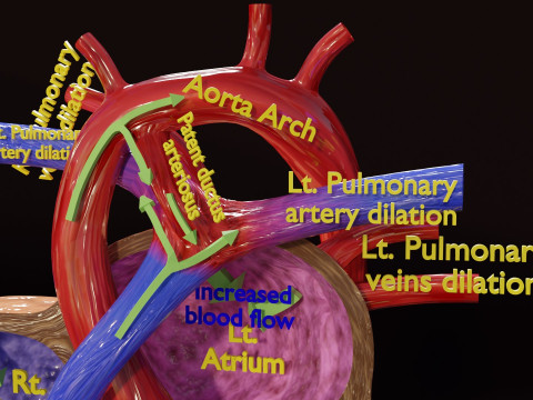 PDA Patent Ductus Arteriosus vs Normal blood circulation 3D Model