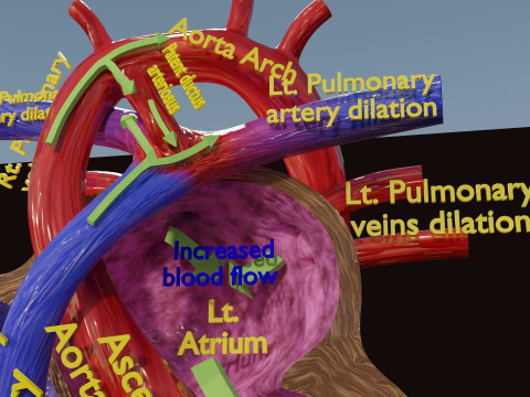 PDA Patent Ductus Arteriosus vs Normal blood circulation 3D Model