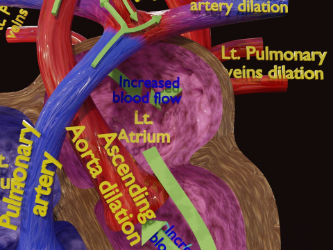 PDA Patent Ductus Arteriosus vs Normal blood circulation 3D Model
