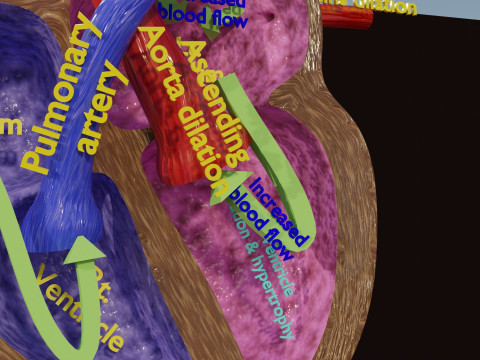 PDA Patent Ductus Arteriosus vs Normal blood circulation 3D Model
