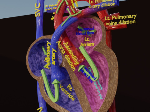 PDA Patent Ductus Arteriosus vs Normal blood circulation 3D Model