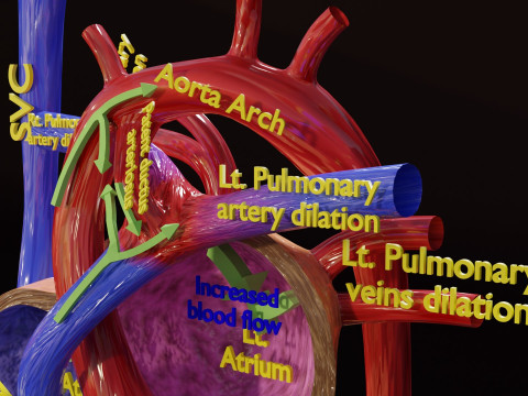 PDA Patent Ductus Arteriosus vs Normal blood circulation 3D Model