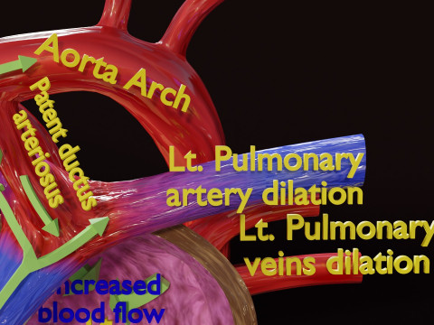 PDA Patent Ductus Arteriosus vs Normal blood circulation 3D Model