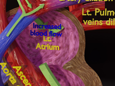 PDA Patent Ductus Arteriosus vs Normal blood circulation 3D Model