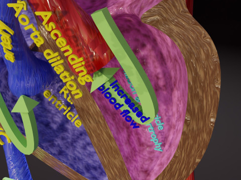 PDA Patent Ductus Arteriosus vs Normal blood circulation 3D Model