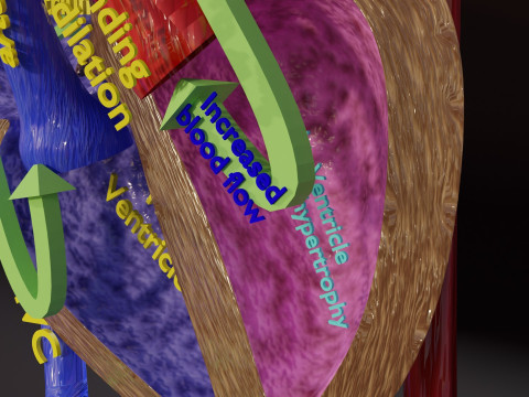 PDA Patent Ductus Arteriosus vs Normal blood circulation 3D Model