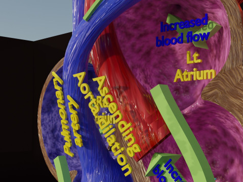 PDA Patent Ductus Arteriosus vs Normal blood circulation 3D Model