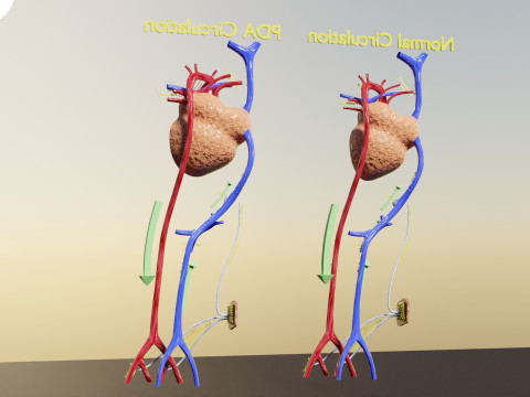 PDA Patent Ductus Arteriosus vs Normal blood circulation 3D Model