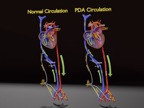 PDA Patent Ductus Arteriosus vs Normal blood circulation 3D Model
