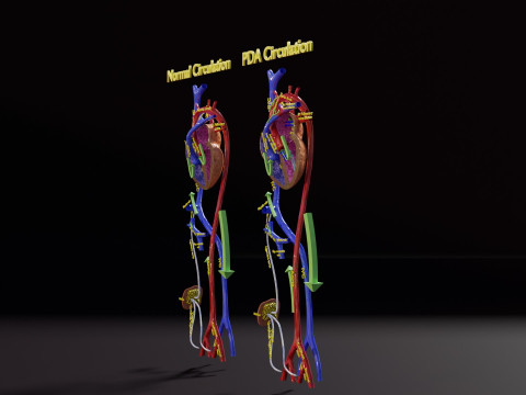PDA Patent Ductus Arteriosus vs Normal blood circulation 3D Model