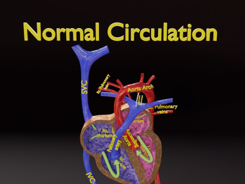 PDA Patent Ductus Arteriosus vs Normal blood circulation 3D Model