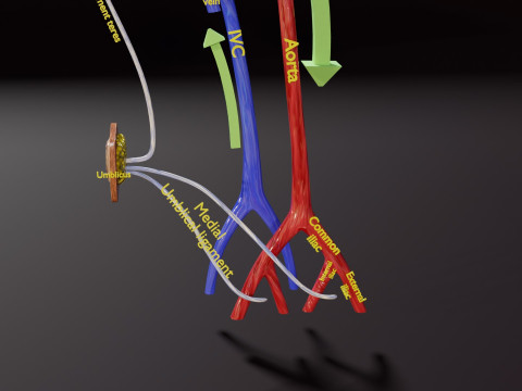PDA Patent Ductus Arteriosus vs Normal blood circulation 3D Model