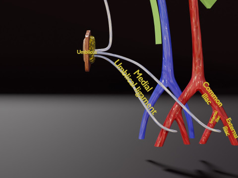 PDA Patent Ductus Arteriosus vs Normal blood circulation 3D Model