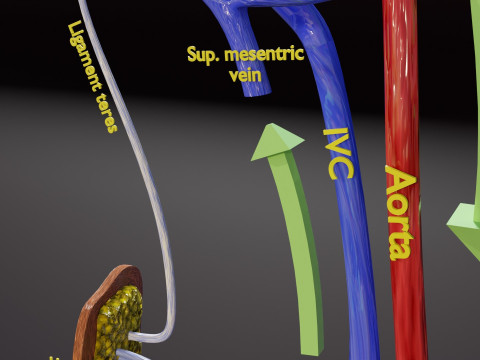 PDA Patent Ductus Arteriosus vs Normal blood circulation 3D Model
